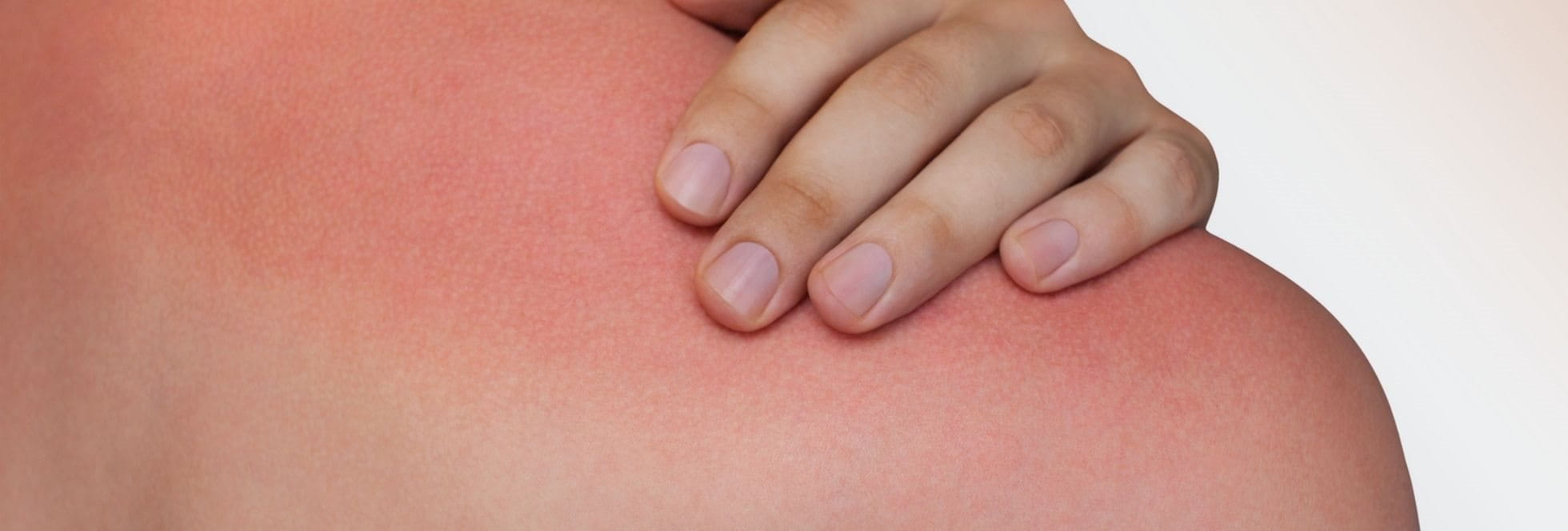 Hoelang duurt het voordat een verbrande